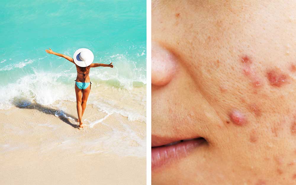 10-Why-Acne-Is-Worse-in-the-Summer—And-How-to-Get-Rid-of-It-shutterstock-ft.jpg